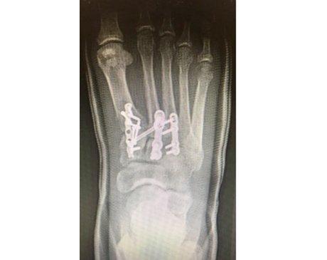 pilon-fracture-after-0524